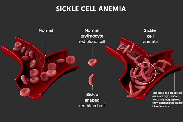 Out of 64K Anemia Patients, 2000 Patients Suffer from Sickle Cell Disease - The Indian Practitioner