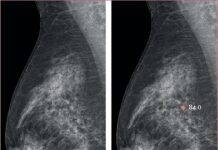 AI-Supported-Breast -Screening -Detects -More -Cancer- Cases