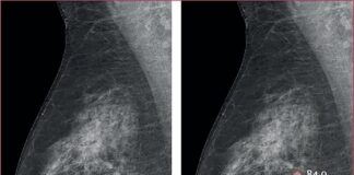 AI-Supported-Breast -Screening -Detects -More -Cancer- Cases