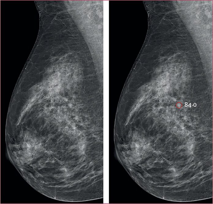 AI-Supported-Breast -Screening -Detects -More -Cancer- Cases