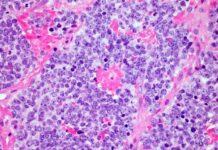 car-t-cell-therapy-achieves-record-breaking-18-year-cancer-remission