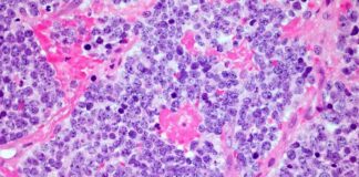 car-t-cell-therapy-sets-18-year-cancer-remission