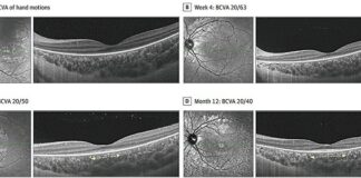 New-Retinal-Disorder-in-Children-Linked-to-Febrile-Illness