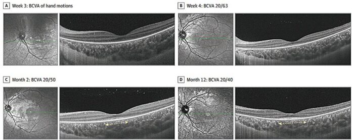 New-Retinal-Disorder-in-Children-Linked-to-Febrile-Illness