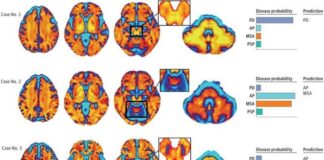 ai-powered-mri-technique-diagnoses-parkinsonian-disorders