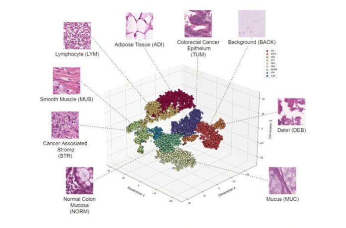 ai-tool-detects-colorectal-cancer-with-96-74-accuracy