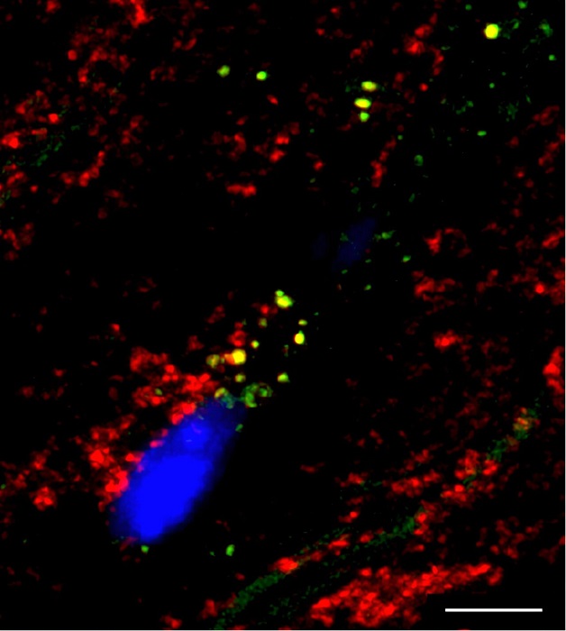Immunotherapy Reverses Cholesterol-Induced Heart Cell Damage immunotherapy-reverses-cholesterol-induced-heart-cell-damage
