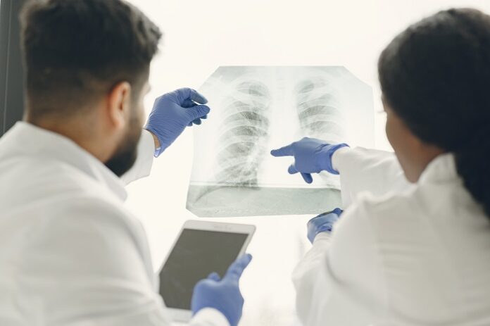 radiation-protocol-shows-better-survival-in-lung-cancer-patients