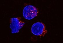 fat-rich-ascites-found-to-weaken-immune-system-in-cancer