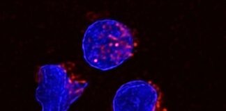 fat-rich-ascites-found-to-weaken-immune-system-in-cancer