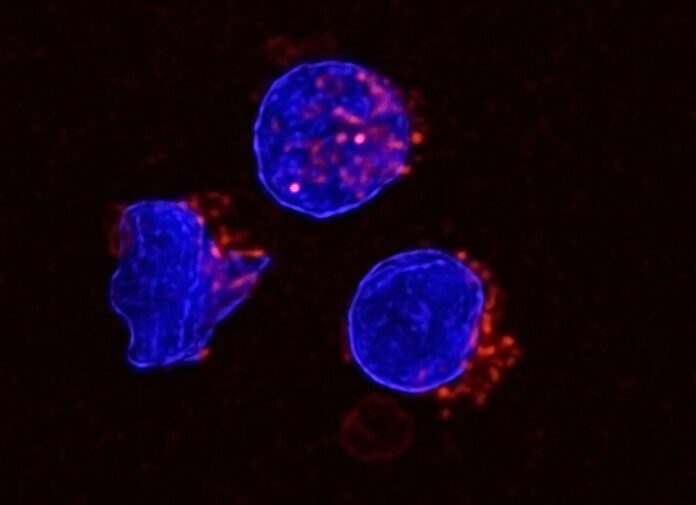 Fat-Rich Ascites Found to Weaken Immune System in Cancer fat-rich-ascites-found-to-weaken-immune-system-in-cancer