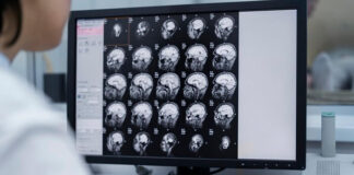 doctors-urge-early-detection-as-brain-tumour-cases-climb