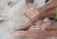 leprosy-in-visakhapatnam-high-disability-rates-transmission
