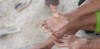 leprosy-in-visakhapatnam-high-disability-rates-transmission