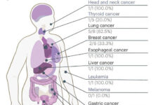 blood-test-shows-accuracy-in-detecting-multiple-cancers-early