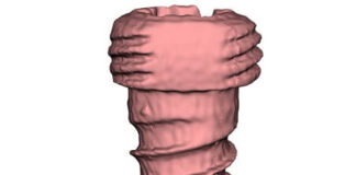 screw-stability-in-bone-surgery-a-new-frontier-in-orthopaedics