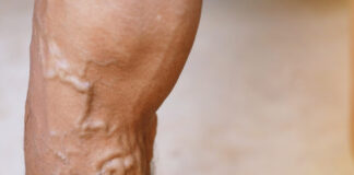 rising-cases-of-varicose-veins-in-men-a-health-concern