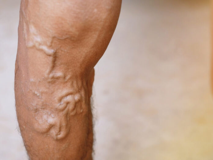 Rising Cases of Varicose Veins in Men : A Health Concern rising-cases-of-varicose-veins-in-men-a-health-concern