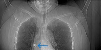 aster-cmi-doctors-remove-metal-pin-lodged-in-womans-lung