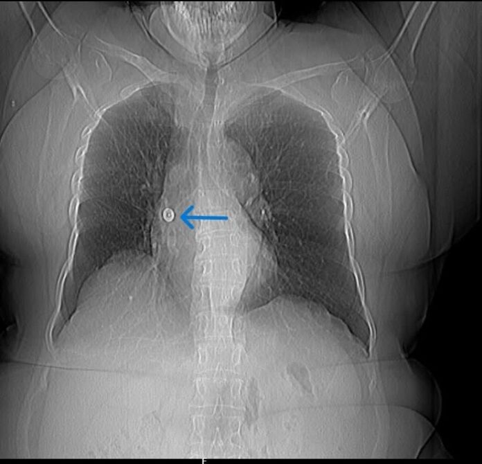 Aster CMI Doctors Safely Remove Metal Pin Lodged in Woman’s Lung for Over a Month aster-cmi-doctors-remove-metal-pin-lodged-in-womans-lung