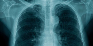 sion-hospital-launches-lab-for-drug-resistant-tb