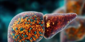 three-in-five-liver-cancer-cases-are-preventable