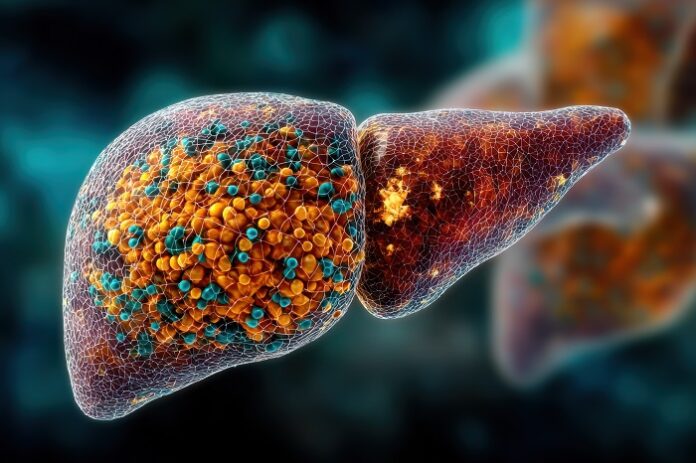 Three in Five Liver Cancer Cases Are Preventable three-in-five-liver-cancer-cases-are-preventable