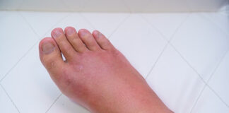 cvi-the-silent-vascular-condition-affecting-millions-over-50