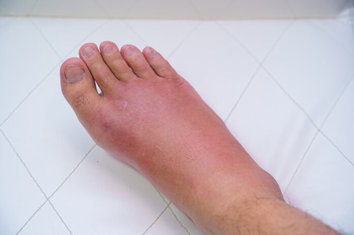 CVI: The Silent Vascular Condition Affecting Millions Over 50 cvi-the-silent-vascular-condition-affecting-millions-over-50