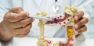 childhood-bacterial-toxin-exposure-may-accelerate-colon-cancer