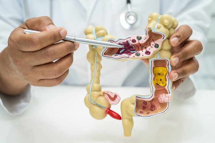 childhood-bacterial-toxin-exposure-may-accelerate-colon-cancer