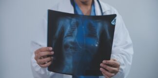misdiagnosed-as-tb-saved-by-targeted-therapy