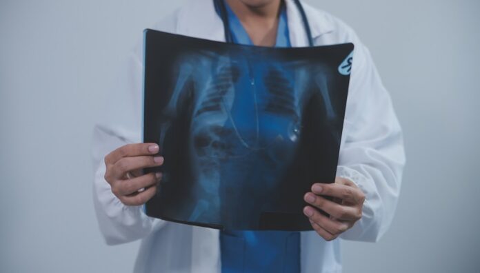 Misdiagnosed as TB, Saved by Targeted Therapy misdiagnosed-as-tb-saved-by-targeted-therapy