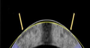 researchers-explore-incision-free-alternative-to-lasik