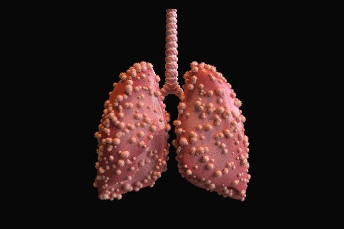 three-month-old-diagnosed-with-drug-resistant-tb