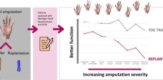 toe-transfer-surgery-shows-hand-function-over-replantation