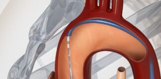 edwards-lifesciences-launches-next-generation-transcatheter-heart-valve-in-india