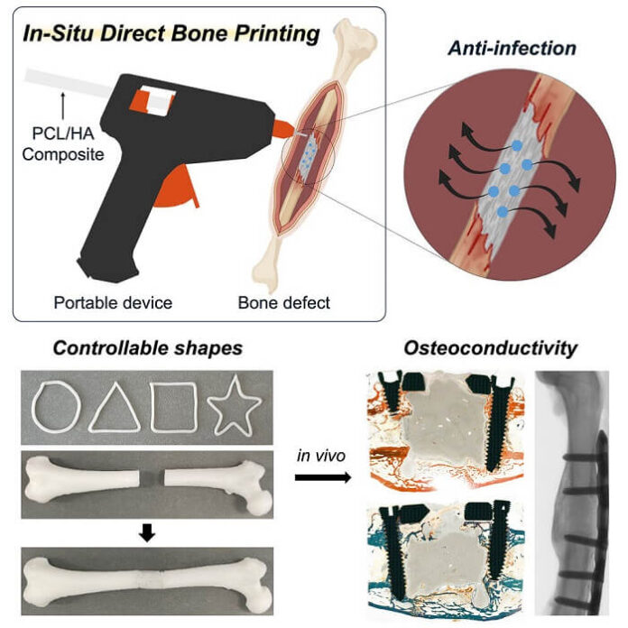 Scientists Create Glue-Gun Inspired Tool for Bone Repair scientists-create-glue-gun-inspired-tool-for-bone-repair