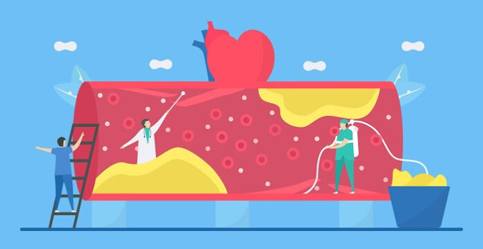 Lower Cholesterol Linked to Reduced Dementia Risk lower-cholesterol-linked-to-reduced-dementia-risk