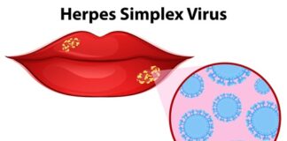 antiviral-approach-may-halt-herpes-simplex-virus-outbreaks