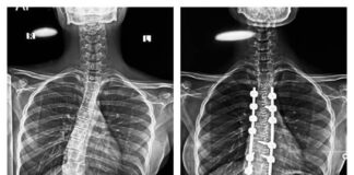 wockhardt-hospitals-performs-complex-corrective-surgery-for-severe-scoliosis