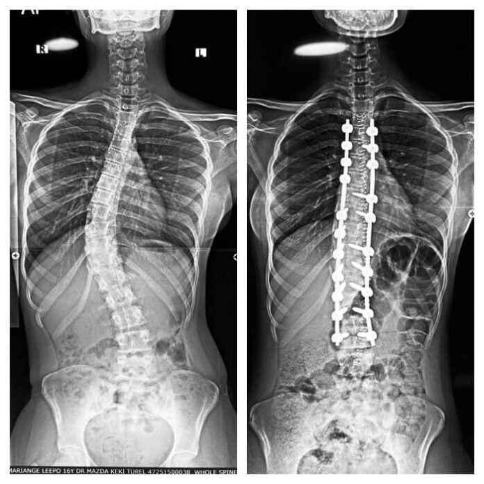 wockhardt-hospitals-performs-complex-corrective-surgery-for-severe-scoliosis