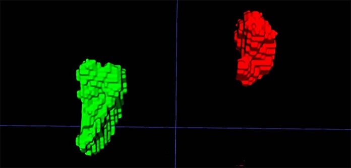 ai-model-detects-first-imaging-biomarker-of-chronic-stress