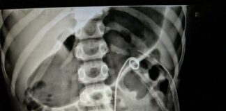ainu-performs-complex-pediatric-kidney-stone-removal