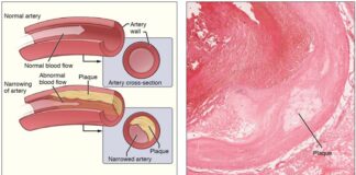 car-t-therapy-may-redefine-treatment-for-heart-disease