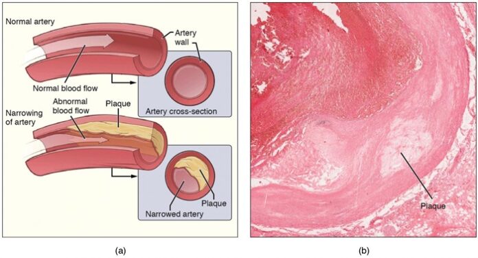car-t-therapy-may-redefine-treatment-for-heart-disease