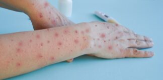 global-measles-deaths-fall-88-but-cases-surge-to-11-million