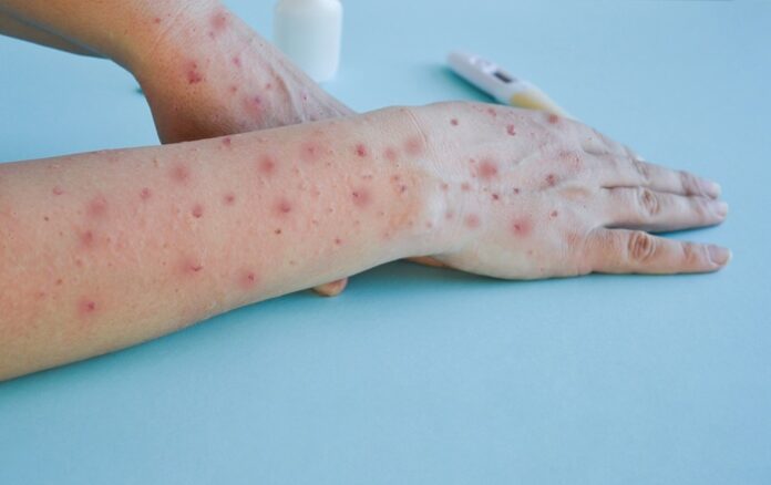 Global Measles Deaths Fall 88%, But Cases Surge to 11 Million global-measles-deaths-fall-88-but-cases-surge-to-11-million