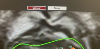 ultrasound-technique-shows-strong-results-for-prostate-cancer