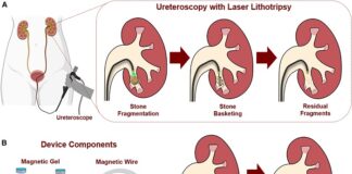 stanford-develops-magnetic-device-to-retrieve-kidney-stones-more-efficiently
